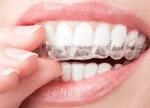 Alinhador transparente Invisalign