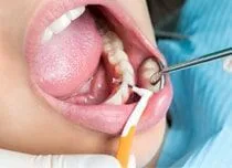 Limpeza interdental